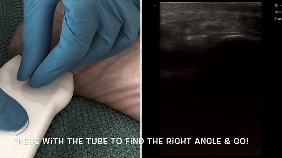 Pecking4plantarfasciopathy